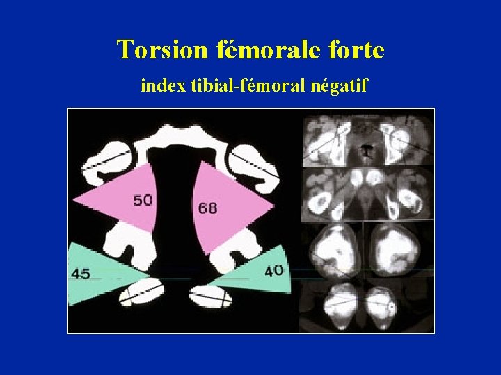 Torsion fémorale forte index tibial-fémoral négatif 