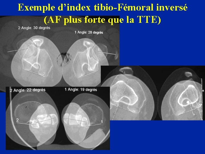 Exemple d’index tibio-Fémoral inversé (AF plus forte que la TTE) 
