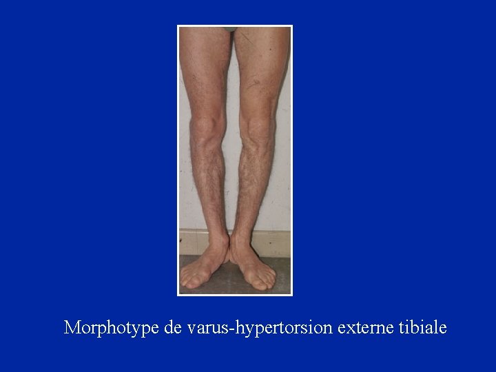 Morphotype de varus-hypertorsion externe tibiale 