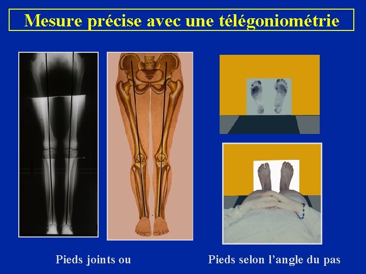 Mesure précise avec une télégoniométrie Pieds joints ou Pieds selon l’angle du pas 