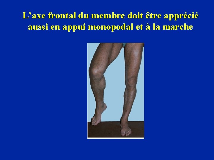 L’axe frontal du membre doit être apprécié aussi en appui monopodal et à la