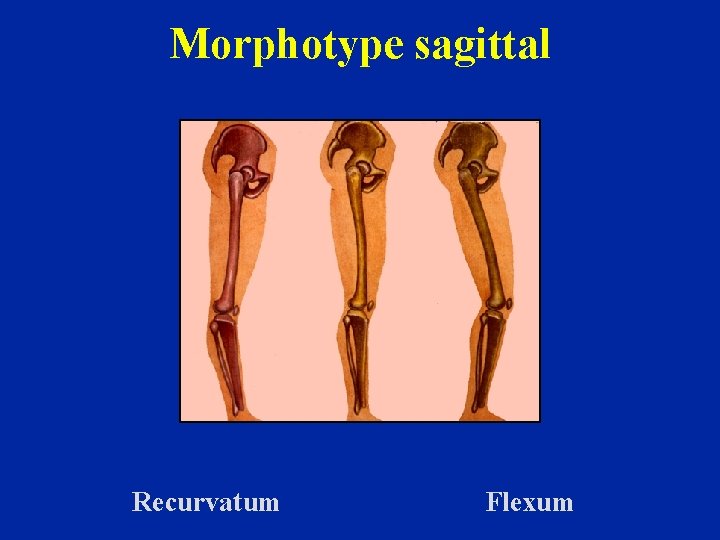 Morphotype sagittal Recurvatum Flexum 