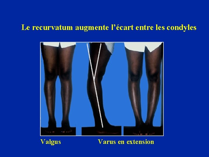 Le recurvatum augmente l’écart entre les condyles Valgus Varus en extension 