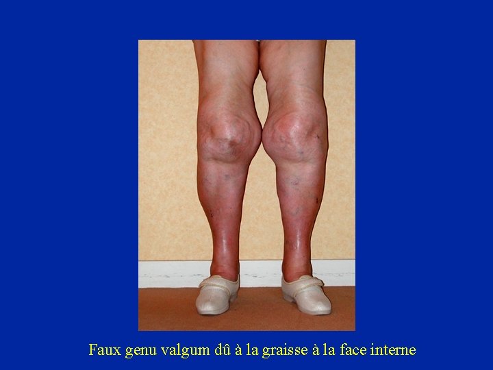 Faux genu valgum dû à la graisse à la face interne 