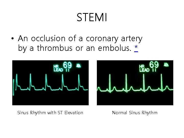 STEMI • An occlusion of a coronary artery by a thrombus or an embolus.