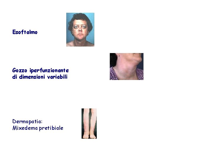 Esoftalmo Gozzo iperfunzionante di dimensioni variabili Dermopatia: Mixedema pretibiale 