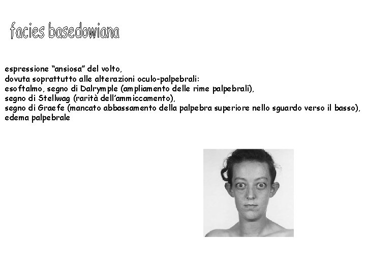 espressione “ansiosa” del volto, dovuta soprattutto alle alterazioni oculo-palpebrali: esoftalmo, segno di Dalrymple (ampliamento