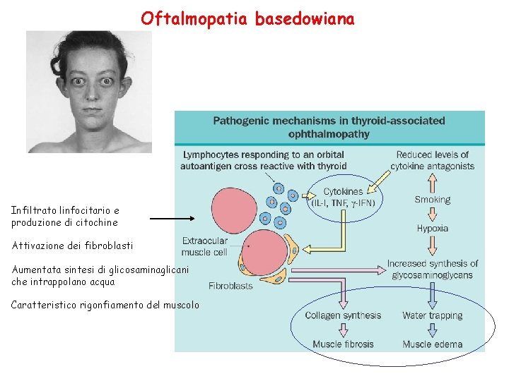 Oftalmopatia basedowiana Infiltrato linfocitario e produzione di citochine Attivazione dei fibroblasti Aumentata sintesi di