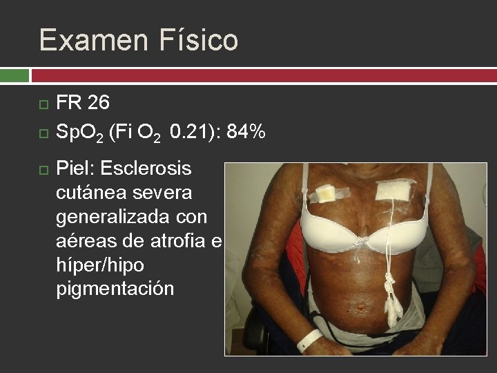 Examen Físico FR 26 Sp. O 2 (Fi O 2 0. 21): 84% Piel: