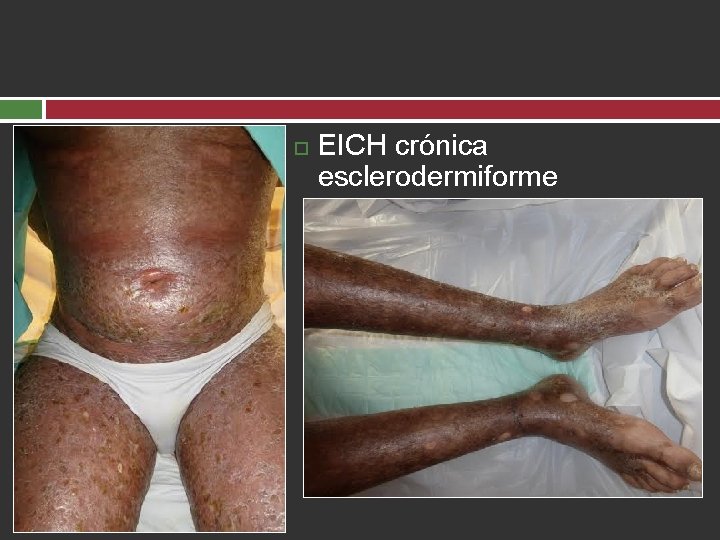  EICH crónica esclerodermiforme 