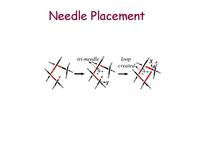 Needle Placement 