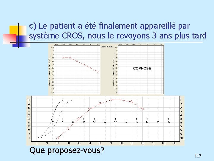 c) Le patient a été finalement appareillé par système CROS, nous le revoyons 3