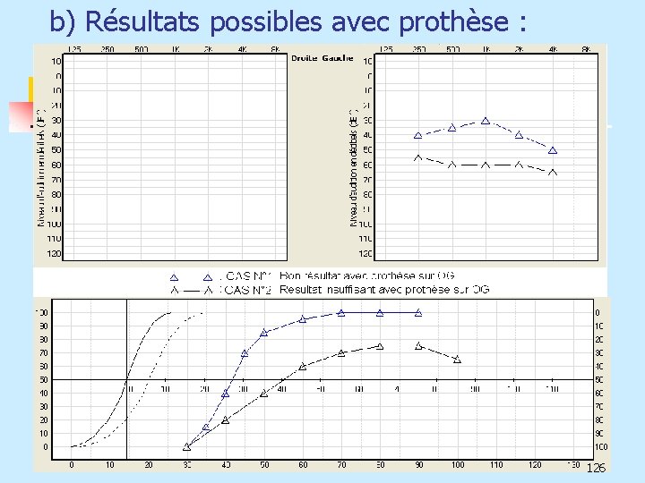 b) Résultats possibles avec prothèse : 126 