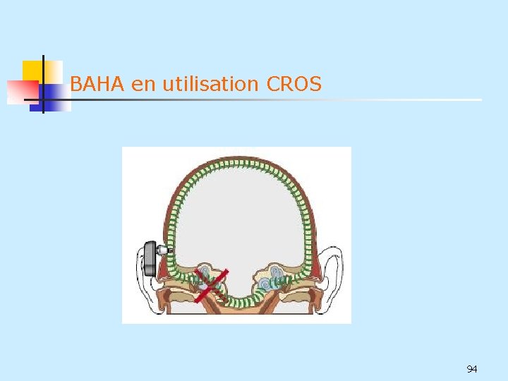 BAHA en utilisation CROS 94 