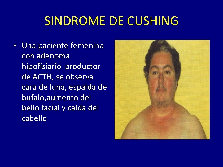 SINDROME DE CUSHING • Una paciente femenina con adenoma hipofisiario productor de ACTH, se