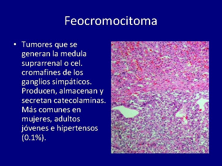 Feocromocitoma • Tumores que se generan la medula suprarrenal o cel. cromafines de los
