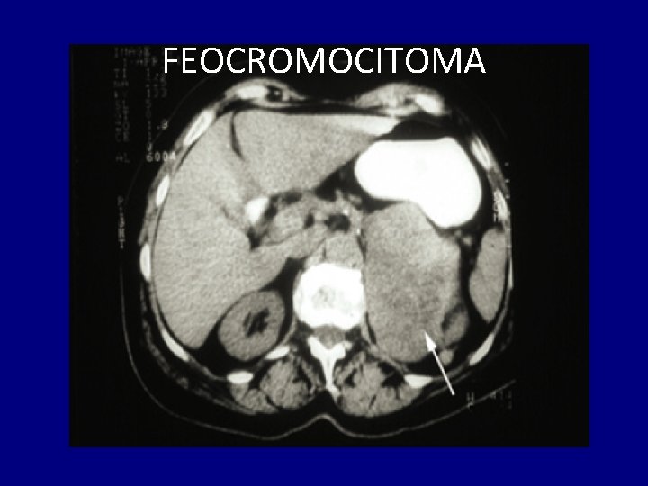 FEOCROMOCITOMA 
