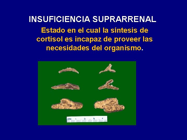 INSUFICIENCIA SUPRARRENAL Estado en el cual la síntesis de cortisol es incapaz de proveer