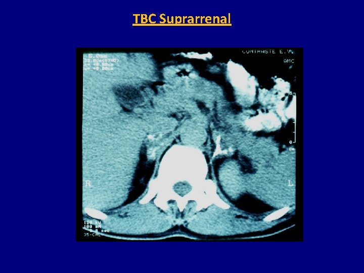 TBC Suprarrenal 