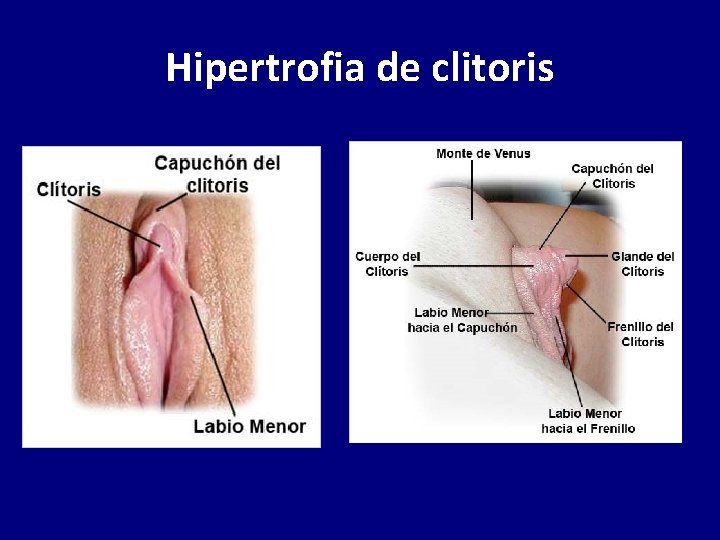 Hipertrofia de clitoris 