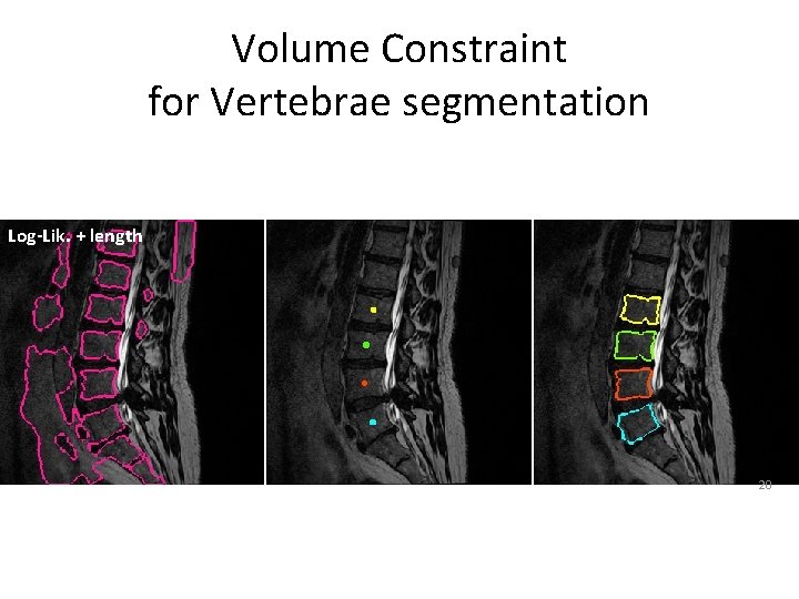 Volume Constraint for Vertebrae segmentation Log-Lik. + length 20 