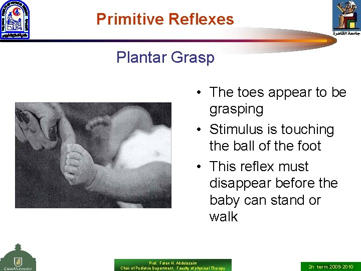 Primitive Reflexes Plantar Grasp • The toes appear to be grasping • Stimulus is