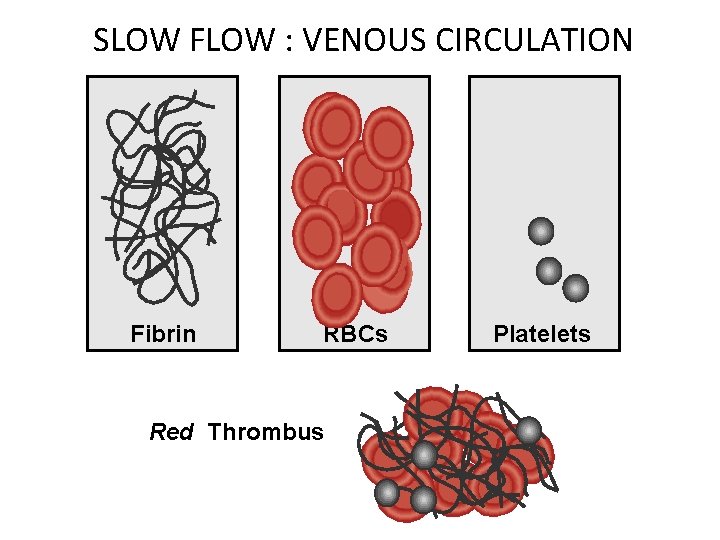 SLOW FLOW : VENOUS CIRCULATION Fibrin RBCs Red Thrombus Platelets 