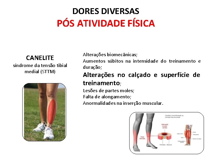 DORES DIVERSAS PÓS ATIVIDADE FÍSICA CANELITE síndrome da tensão tibial medial (STTM) Alterações biomecânicas;