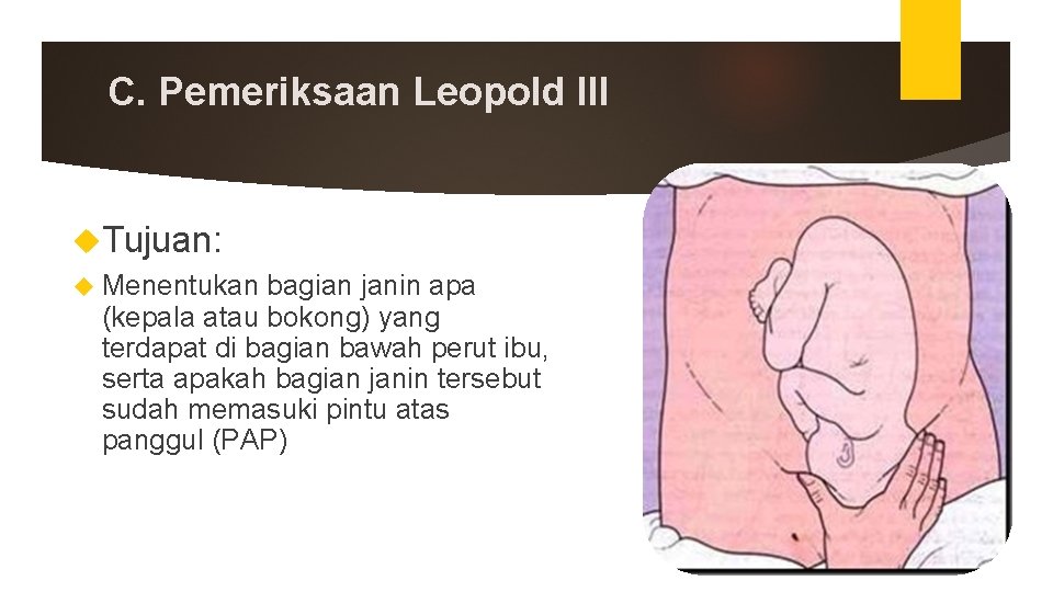 C. Pemeriksaan Leopold III Tujuan: Menentukan bagian janin apa (kepala atau bokong) yang terdapat C. Pemeriksaan Leopold III Tujuan: Menentukan bagian janin apa (kepala atau bokong) yang terdapat