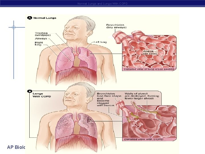 Normal Lungs and Lungs With COPD AP Biology 