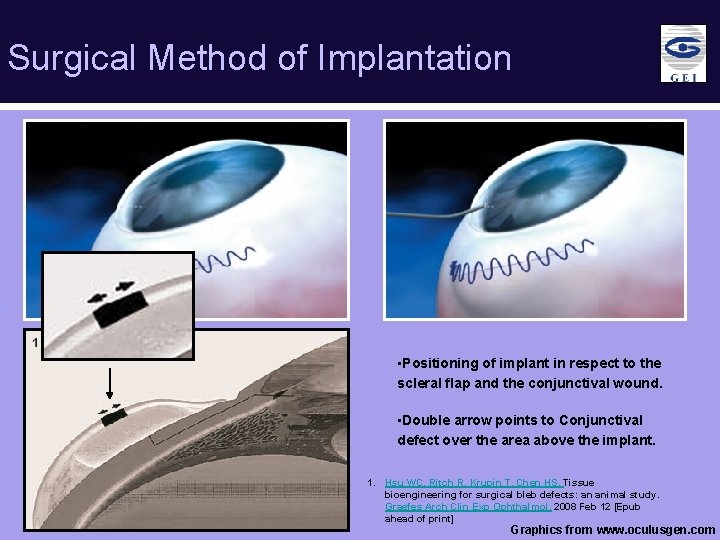 Surgical Method of Implantation v • Positioning of implant in respect to the scleral