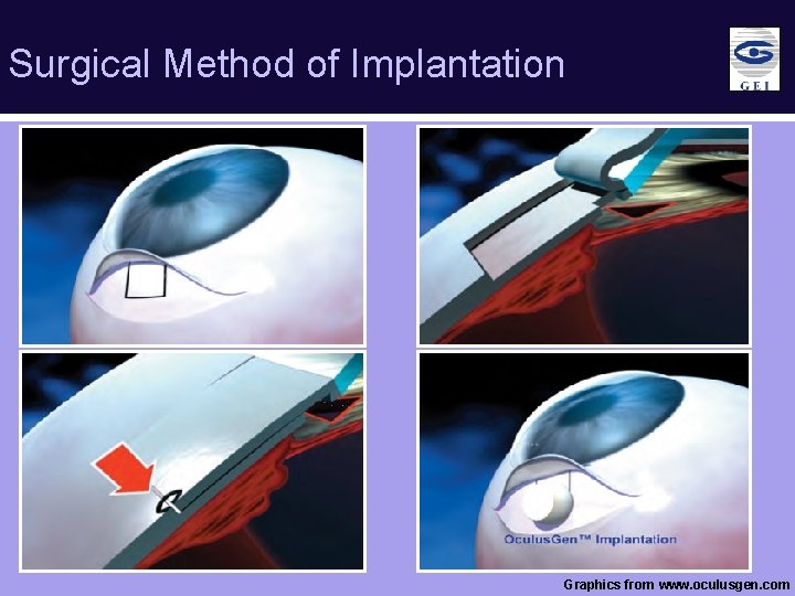 Surgical Method of Implantation v Graphics from www. oculusgen. com 
