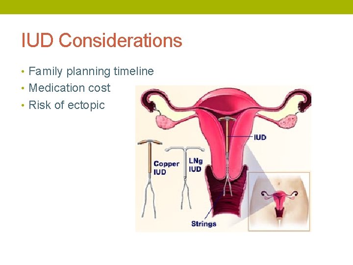 IUD Considerations • Family planning timeline • Medication cost • Risk of ectopic 