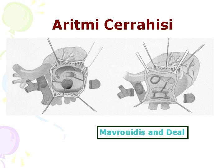 Aritmi Cerrahisi Mavrouidis and Deal 