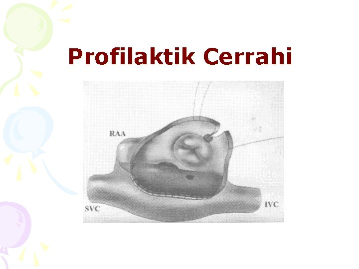 Profilaktik Cerrahi 