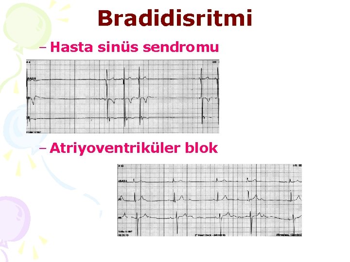 Bradidisritmi – Hasta sinüs sendromu – Atriyoventriküler blok 