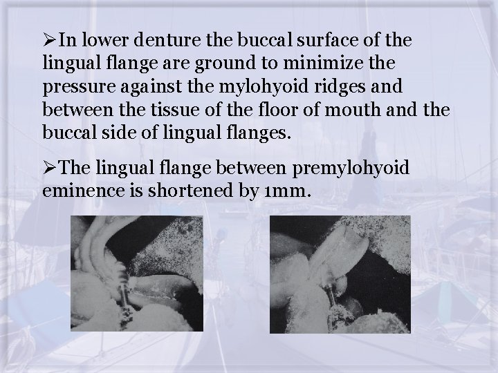 ØIn lower denture the buccal surface of the lingual flange are ground to minimize