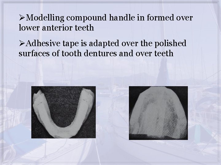 ØModelling compound handle in formed over lower anterior teeth ØAdhesive tape is adapted over