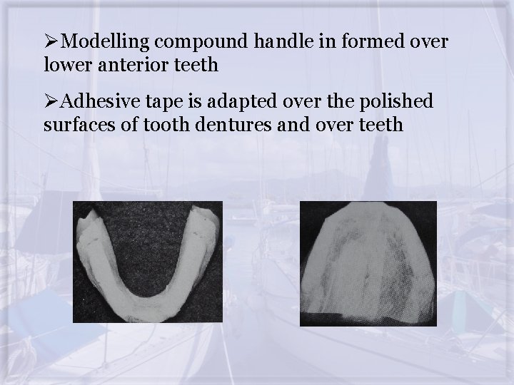 ØModelling compound handle in formed over lower anterior teeth ØAdhesive tape is adapted over