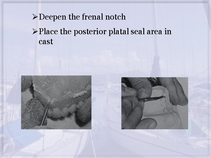 ØDeepen the frenal notch ØPlace the posterior platal seal area in cast 