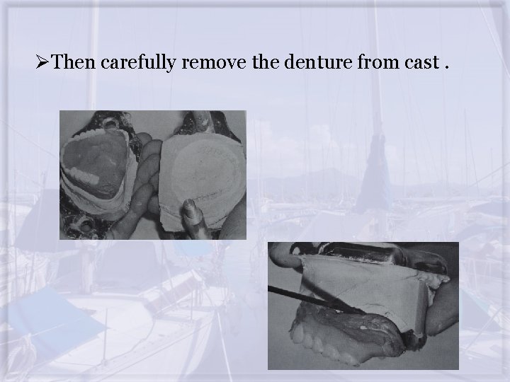 ØThen carefully remove the denture from cast. 