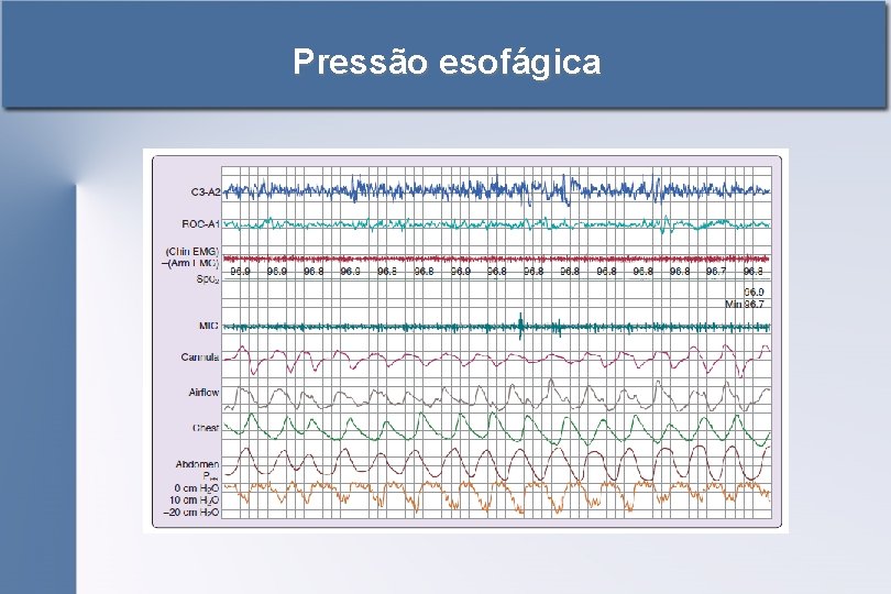 Pressão esofágica 