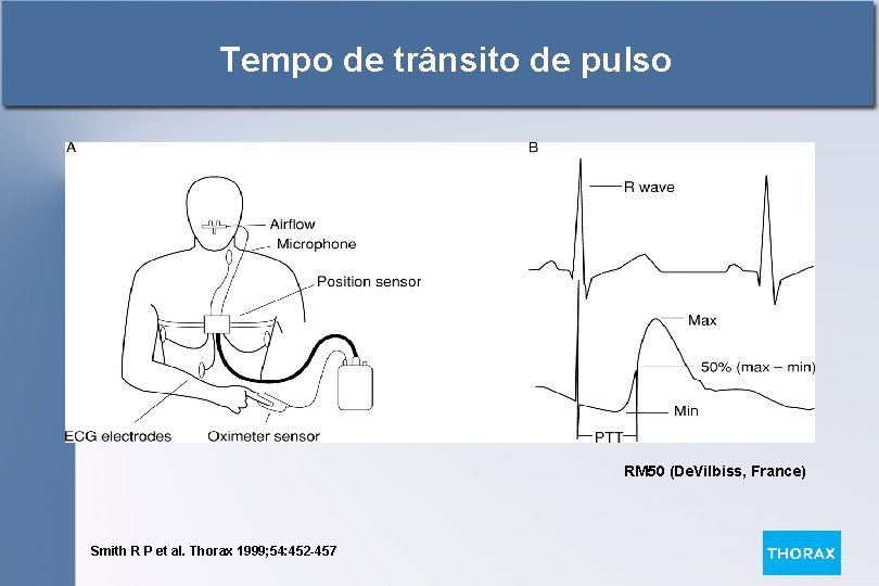 Tempo de trânsito de pulso RM 50 (De. Vilbiss, France) Smith R P et