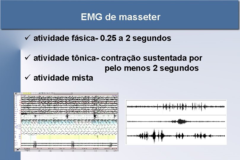 EMG de masseter ü atividade fásica- 0. 25 a 2 segundos ü atividade tônica-