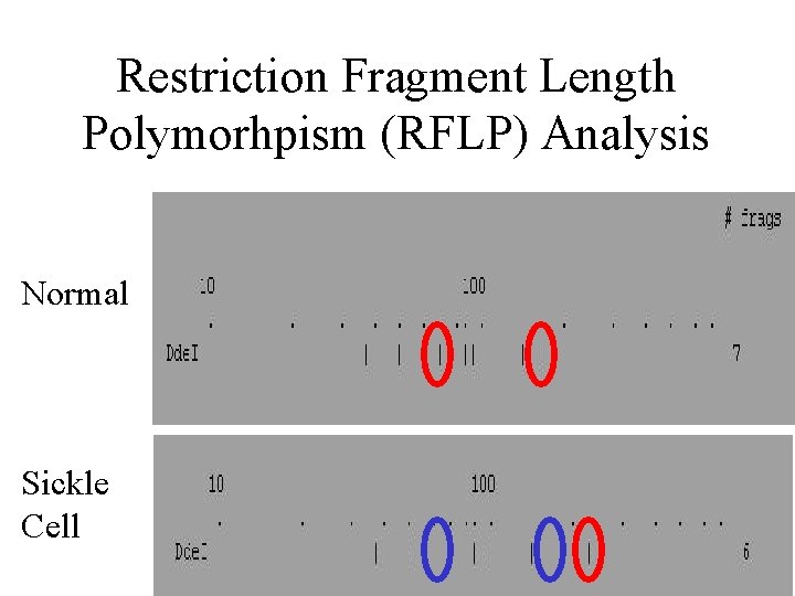 Restriction Fragment Length Polymorhpism (RFLP) Analysis Normal Sickle Cell 