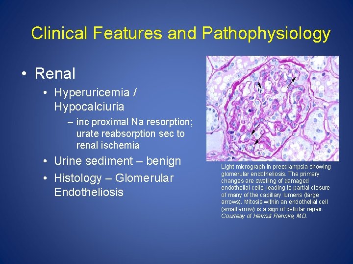 Clinical Features and Pathophysiology • Renal • Hyperuricemia / Hypocalciuria – inc proximal Na