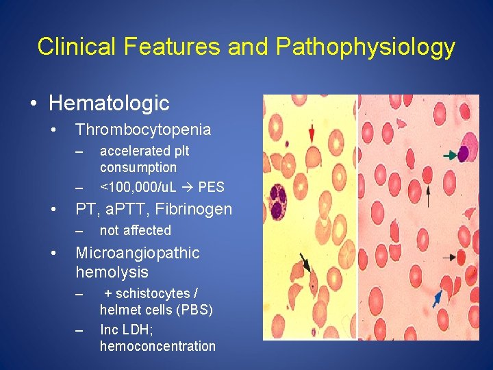 Clinical Features and Pathophysiology • Hematologic • Thrombocytopenia – – • PT, a. PTT,