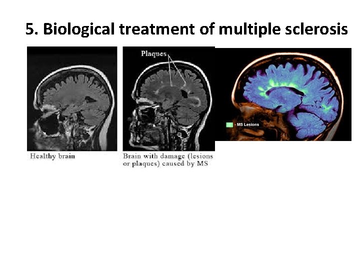 5. Biological treatment of multiple sclerosis 