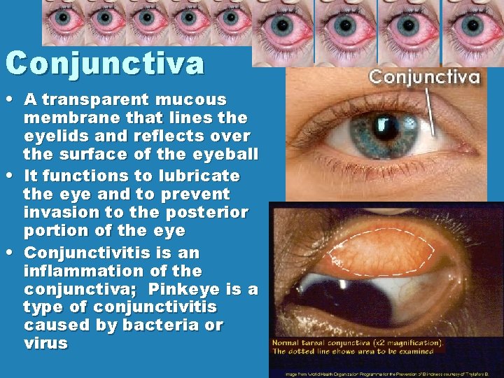 Conjunctiva • A transparent mucous membrane that lines the eyelids and reflects over the