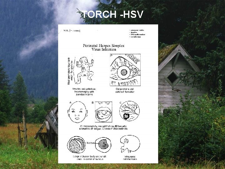 TORCH -HSV 